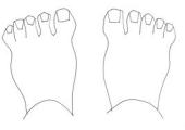 ダウン症 特徴 足の指